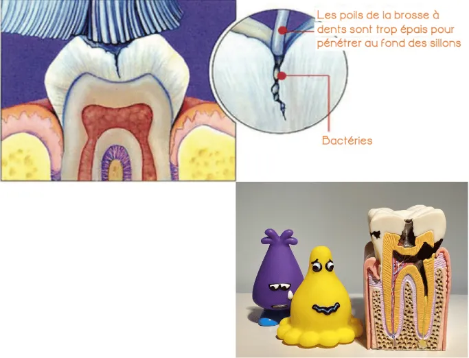Pédodonthie Sillon des molaires